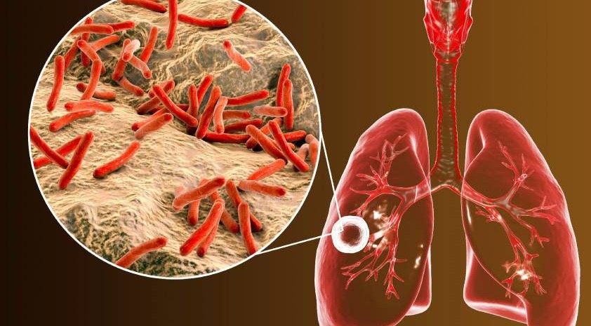 Algoritma Diagnosis TBC Terbaru Menurut Kemenkes